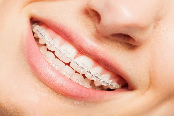 Orthodontic Braces