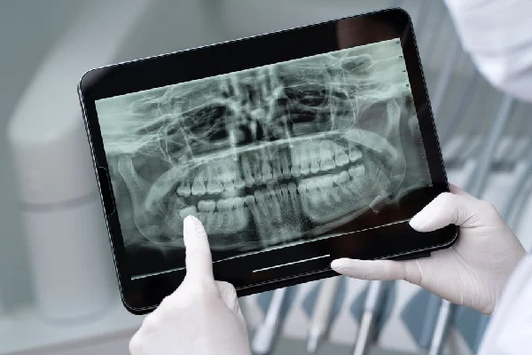Dental RVG X Ray
